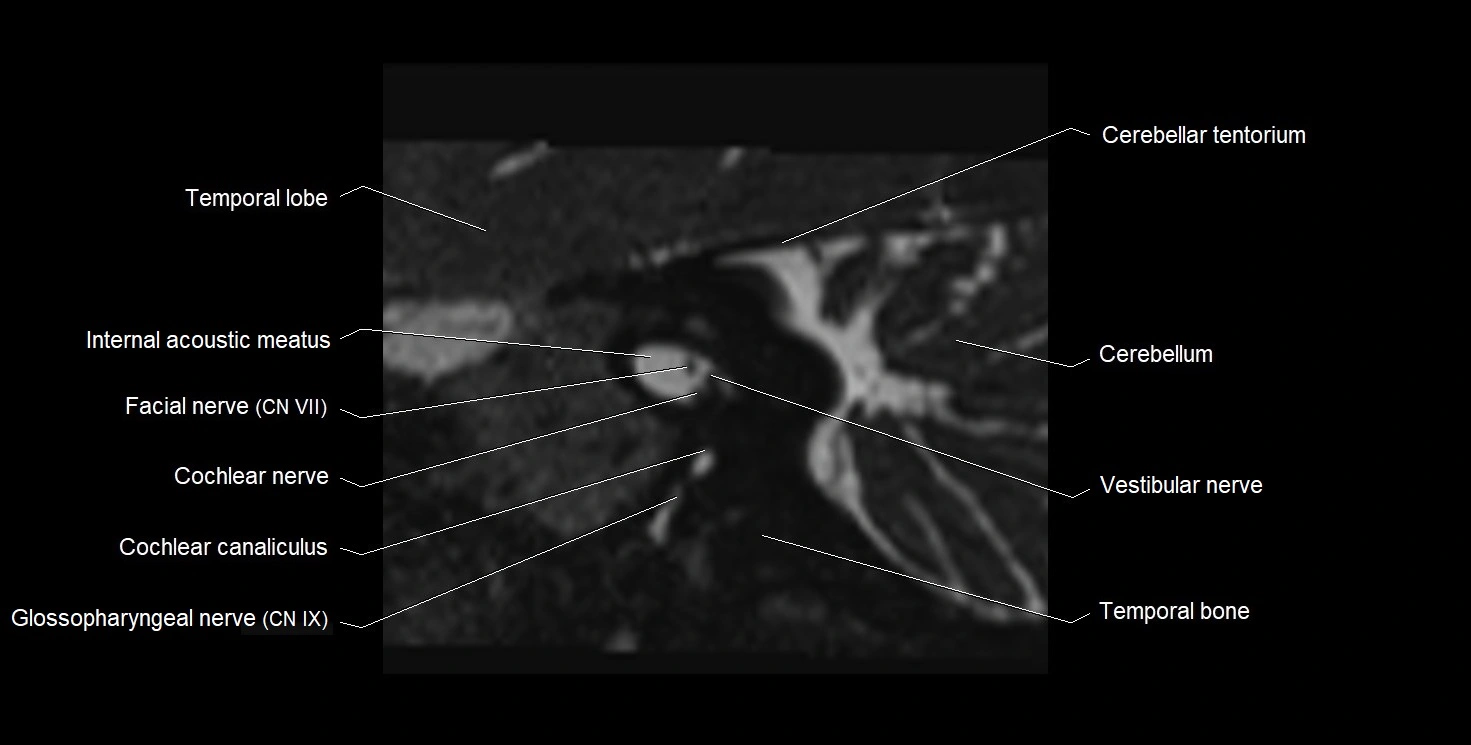 Internal auditory meatus (IAM) 3T sagittal cross sectional anatomy image 22.webp